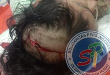 Di Pangururan Seorang Wanita Diduga Dianiaya Hingga Batok Kepala Retak Dan Pendarahan Pada Otak.